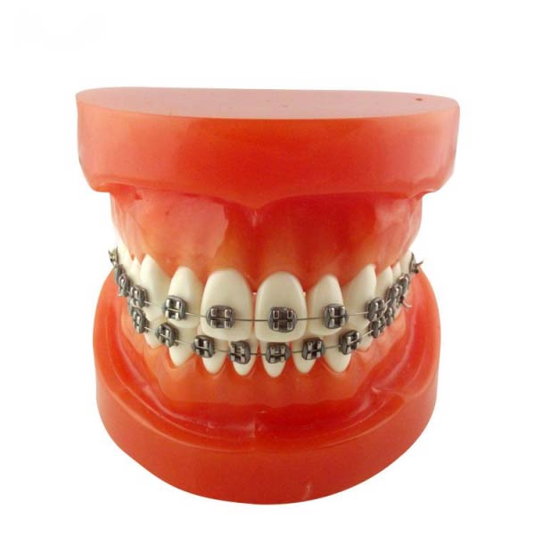 Ceramic Braces, Burnie  The Orthodontic Specialists, Devonport